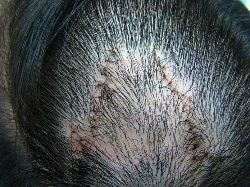 고 찰 Fig. 3. (A) Multiple hair loss patches were seen on the scalp (Pre-operation). (B) Two weeks later from operation. 제 (cefaclor 250 mg bid) 를복용하도록하였다.