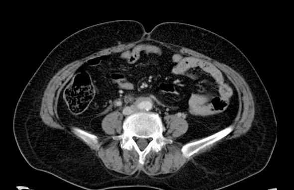 . CT scan before treatment shows retroperitoneal fibrosis obliterating abdominal aorta, inferior vena cava and unenhanced dilatated right ureter. 부통증을주소로내원하였다.