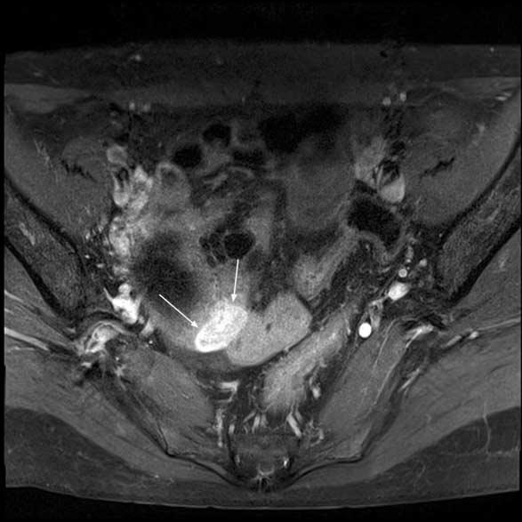 Benign mature cystic teratoma of right ovary in a 40-year-old woman (patient 3 on table 2).