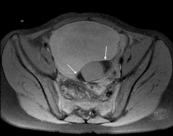 MR Imaging Findings of Ovarian Mature Teratomas with Enhancing Solid Portion Ovarian Mature Enhancing Teratoma Solid Portion Patient Size Location Size Appearance