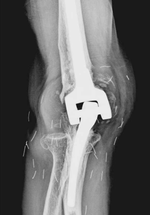 삽입물주위골절 : 삽입물주위골절은주로골다공증이심한환자에서치환물의이완이진행된 humeral component 주위에발생하며 (Fig. 3) revision 및 strut allograft를사용한보강유합술로좋은결과를얻을수있다.