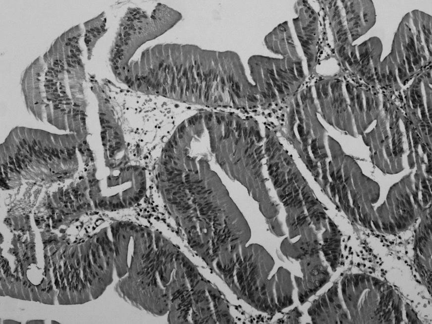 208ㆍ대한소아소화기영양학회지 제 10 권 제 2 호 2007 Fig. 4. (A) Serrated adenoma with serrated glandular pattern and dense eosinophilic cytoplasm (H&E, 400).