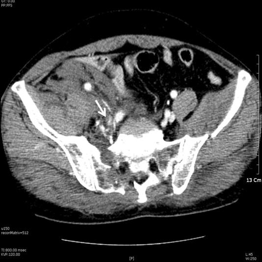 342 박기철 혈역학적불안정성 Fig. 1. A 67 year old man was sustained pelvic bone fracture. Enhanced abdominal CT showed extravasation of contrast in right internal iliac artery injury (arrow).