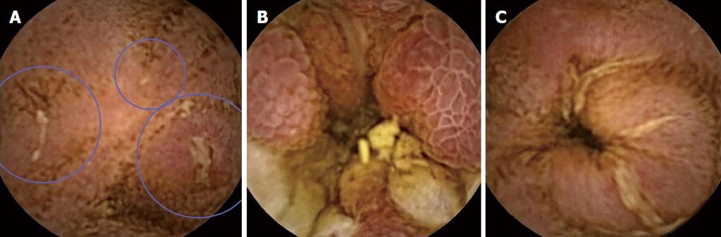 증례 토의 I: 흔하지만 놓쳐서는 안될 소장 캡슐 소견들 A B C Fig. 5. Videocapsule endoscopy findings in Crohn s disease. (A) Small ulcers (encircled); (B) Edematous mucosa; (C) Ulcerated stenosis. A B Fig. 6.