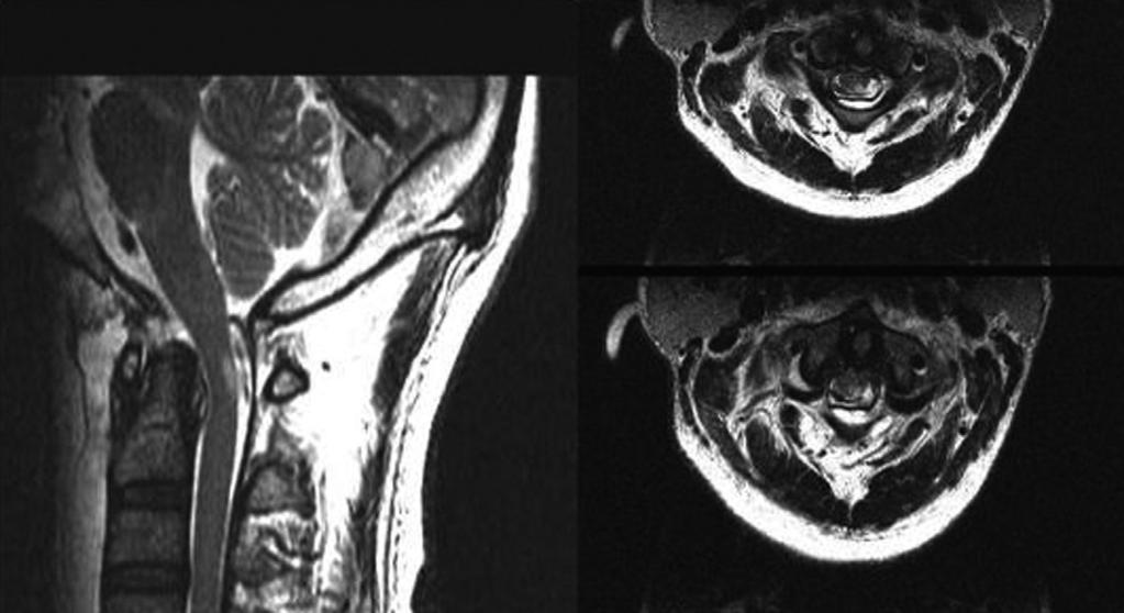dislocation. (A) Initial lateral roentgenographic view. (B, C) Axial CT scans.