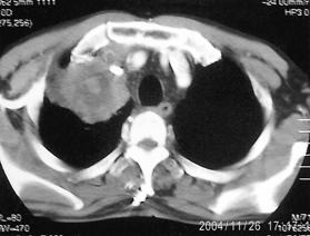 -Hyeon Jeong Kim, et al : Synchronous double cancer of rectal non-hodgkin s lymphoma and lung cancer - Figure 1. Chest CT scan shows ill-defined 6.