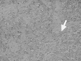 조직학적소견 : 직장에서시행한대장내시경생검조직에서미만성대세포형 (diffuse large cell type) 의비호지킨림프종이관찰되었으며, 면역조직화학염색을통한면역표지자검사에서 leukocyte common antigen (LCA, CD45) 및 Pan-B cell (CD