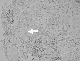 (B) The tumor cells show surface B cell antigen in immunohistochemical staining with monoclonal antibody of CD 20 ( 400, ABC). 으로진단되었다.
