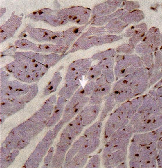 Apoptotic nuclei are stained in brown (white arrow). Panel B showed higher rate of positive cells than Panel (A) and (C).