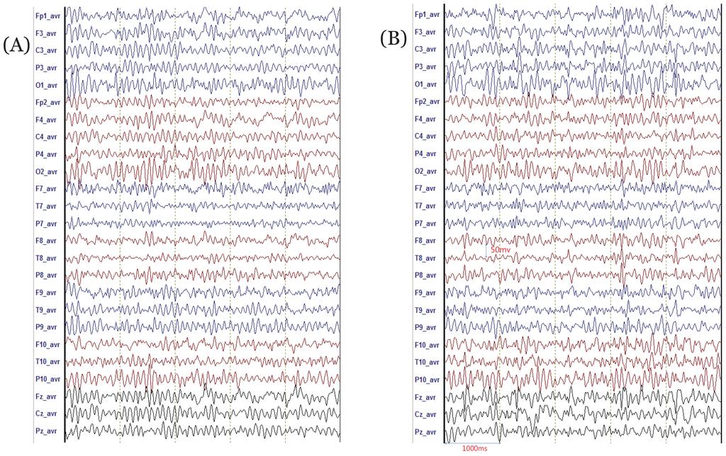 148 Da-hye Jeong, et al. Cerebral-perfusion Reserve after Carotid-artery Stenting Fig. 2. Selected segments of electroencephalography (EEG) for a power spectrum analysis.