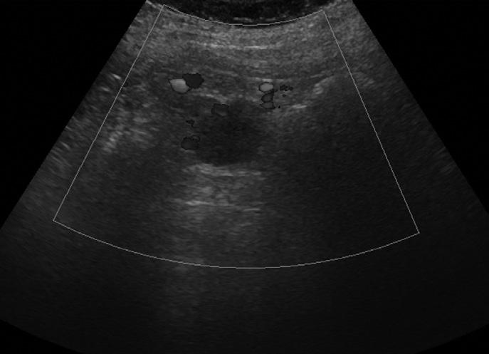Color Doppler ultrasound image shows slightly increased vascular flows at peripheral portion of the masses (B). C, D.