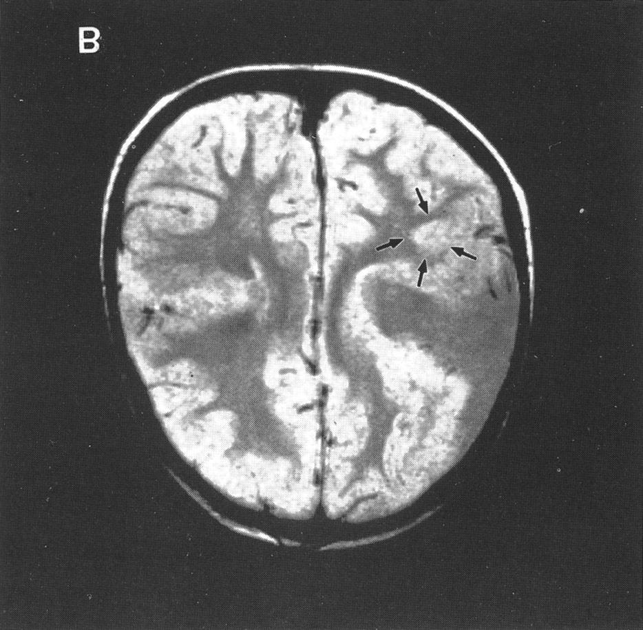 region. B MR images at the same level demonstrates gray matter heterotopia (arrows) adjacent to the open cleft (TR 3200, TE 19). 례의 연령이 적고(증례 1-5), 따라서 장기간 추적이 안 고 안 된 때문일 가능성을 생각해 볼 수 있다.