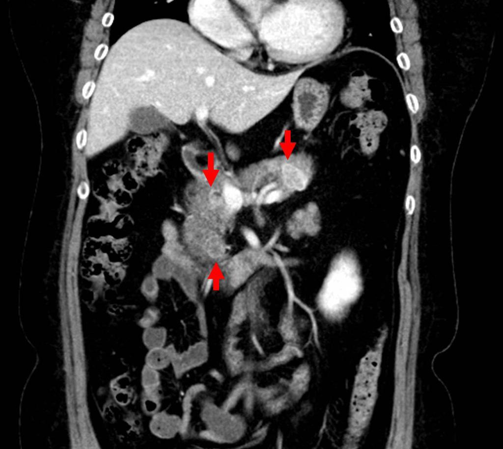 () coronal magnetic resonance image of the sella shows an approximately 1 cm low attenuating lesion on the left side of the pituitary
