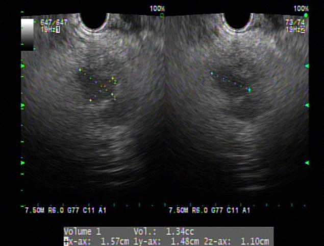 Endoscopic Ultrasonography-Guided Ethanol Injection for a Pancreatic Neuroendocrine Tumor Fig. 4. The second endoscopic ultrasonography-guided ethanol injection.