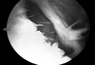 116 이광진 변기용 이석준외 2 인 LPS LPS PO Fig. 1. : r LPS lesion is shown in the arthroscopic view.