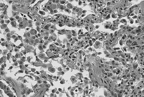 KH Jung et al: Nonclassifiable interstitial pneumonia after allogeneic hematopoietic stem cell transplantation Figure 2.