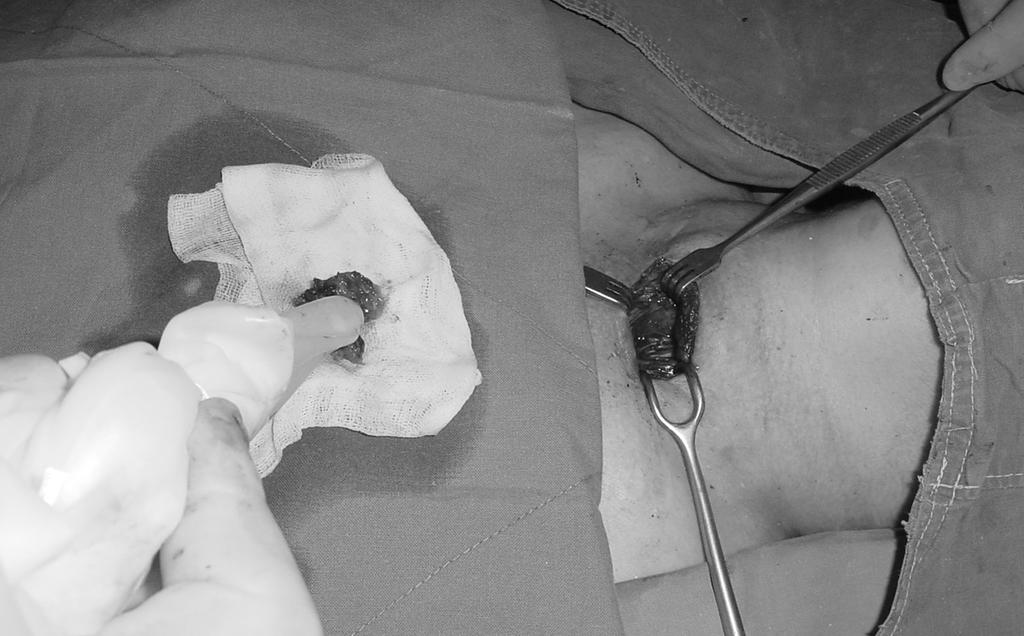 sive parathyroidectomy, MIP)와 99mTc sestamibi scan 재료 및 방법 과 방사능 유도술(radio-guided technique)을 이용한 방