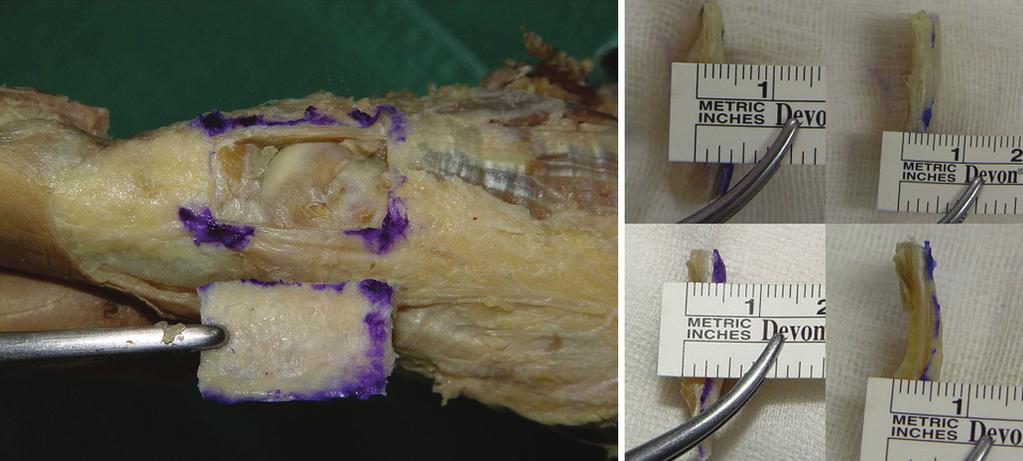 A B Figure 2. (A) In cadavar study, quadriangular capsule was obtained.