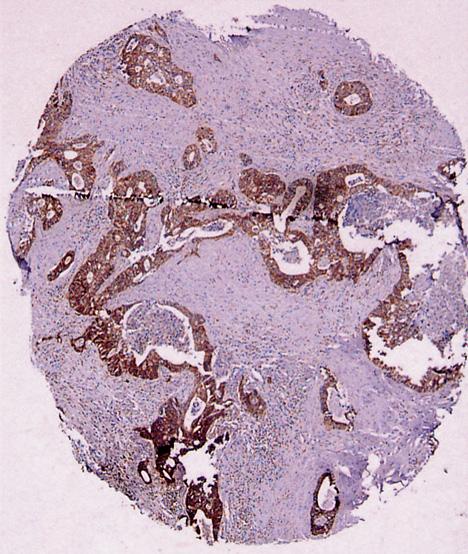 강상범외 : 대장선종및대장선암에서 TGF-β1, 제 2 형 TGF-β 수용체및 VEGF 단백의면역조직화학적발현 317 Figure 2.