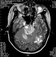 MR Clinical Application e. Metastatic brain tumor 전이성뇌종양은전체두개강내종양의양 10-15% 를차지하며암환자의약 25-30% 가병중에두개강내전이를일으키는것으로알려져있다.
