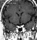 단순 X- 선촬영및 CT에비해 MRI는선명한상을얻을수있고두개골의 artifact가없으며특히고자장 MRI에의한 microadenoma의진단율도증가하고있 다.
