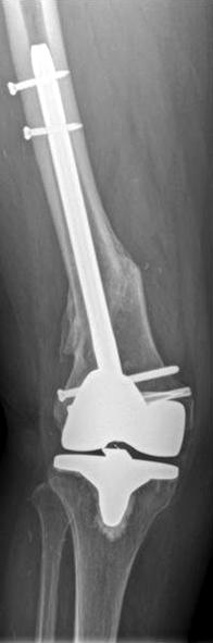Rorabeck type with periprosthetic femoral fracture.