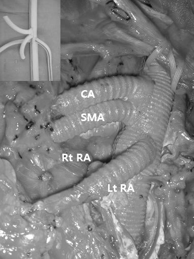 Postoperative MIP image of CT angiography shows well-functioning aortic and visceral arterial grafts (D).
