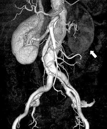 Preoperative 3D image of CT angiography shows dissecting aortic aneurysm extending left external iliac artery and hypoperfusion of left kidney (white arrow) (A).