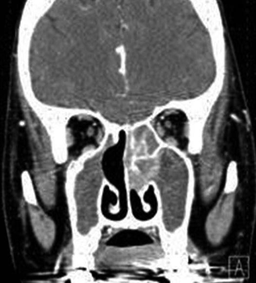 CT scan reveal the right periorbital swelling (A) and soft tissue density on the right sinonasal cavity (B), and