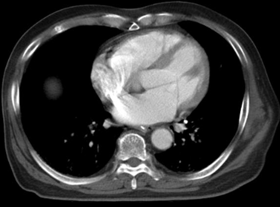 Tuberculosis and Respiratory Diseases Vol. 65. No. 3, Sep. 2008 Figure 3. Contrast pulmonary embolism computed tomography shows filling defect at the left inferior lobar pulmonary arteries. Figure 4.