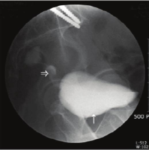 Ji Yeon Lee, et al. A case of rectovesical fi stula after laparoscopy assisted vaginal hysterectomy 피내종양및선침범소견이보였다.