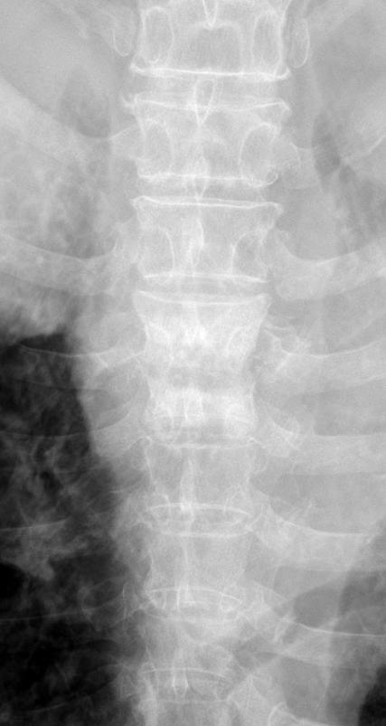 (A) Initial thoracic spine anteroposterior (AP) and lateral radiographs show severe disc