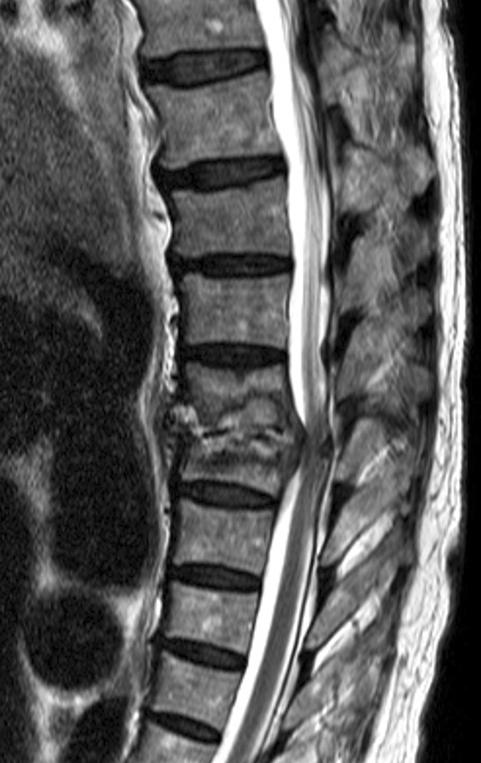 (D) Thoracic spine AP and lateral radiographs taken 12 months after operative treatment show