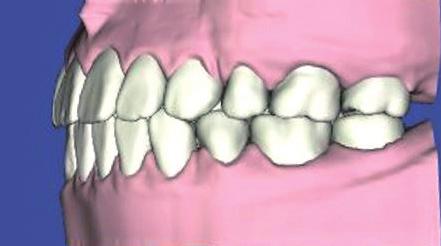 Int J Oral Maxillofac Surg 2012;41:718-726. 3. Park JU, Hwang YS.