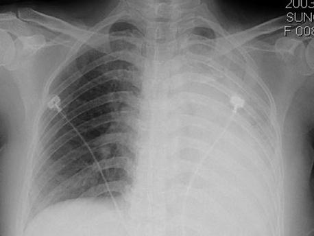 Tuberculosis and Respiratory Diseases Vol. 57. No. 1, Jul, 2004 Figure 4. Chest PA radiograph on hospital day 3 shows collapse and consolidation of the left lung.