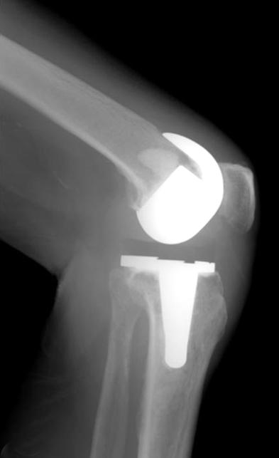 양상훈외 : 슬관절전치환술후발생한지연성동맥폐쇄및신경마비 117 Fig. 5. Knee anterior-posterior (A) and lateral (B) radiograph at 6 months follow-up after total knee arthroplasty. 지 C-반응성단백은 0.