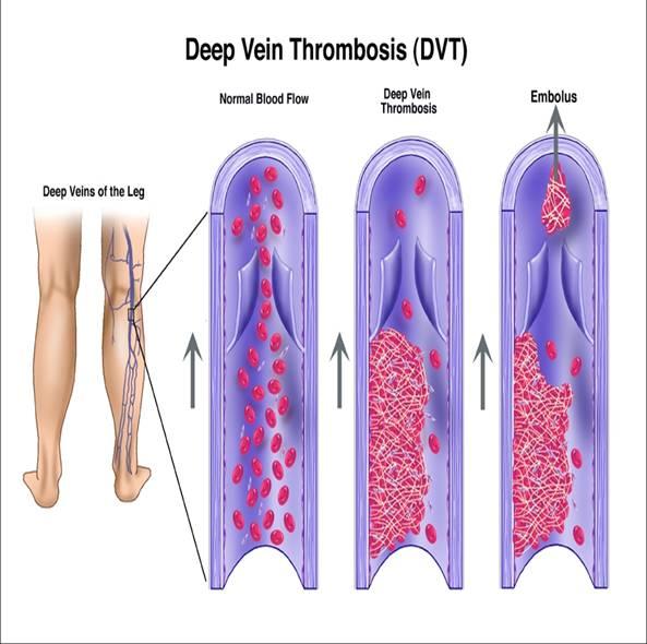 정맥질환 : 심부정맥혈전증 (DVT : Deep vein