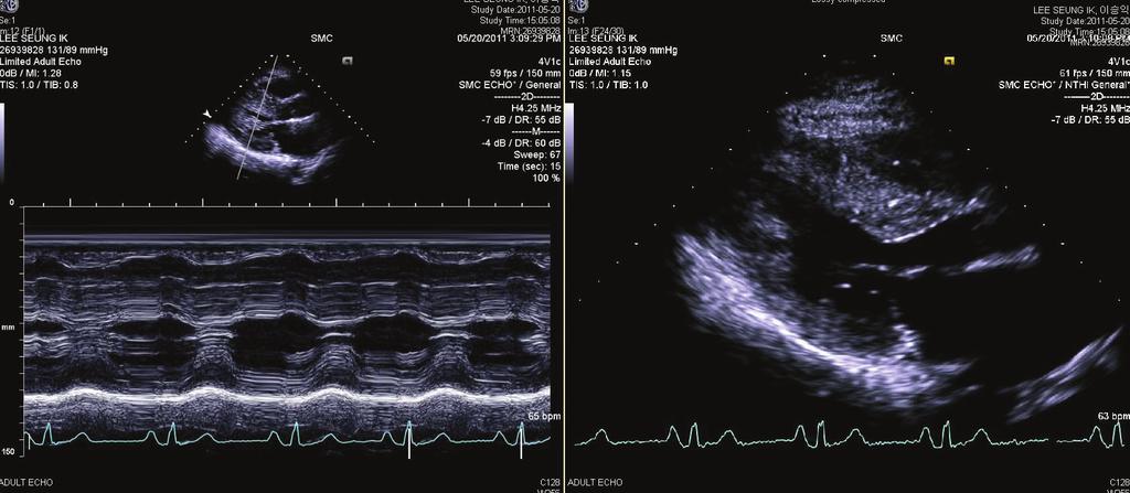 Figure 2. Transthoracic echocardiogram showed asymmetric septal hypertrophy, compatible with hypertrophic cardiomyopathy. 며, 부적절한 ICD 전기충격도 사망률을 증가시키는 것으로 보고하였다.