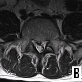 Sagittal(A) and axial(b) T 2 weighted MRI showing central disc extrusion to Rt paracentral aspects at the L 4-5 and disc degeneration at the L