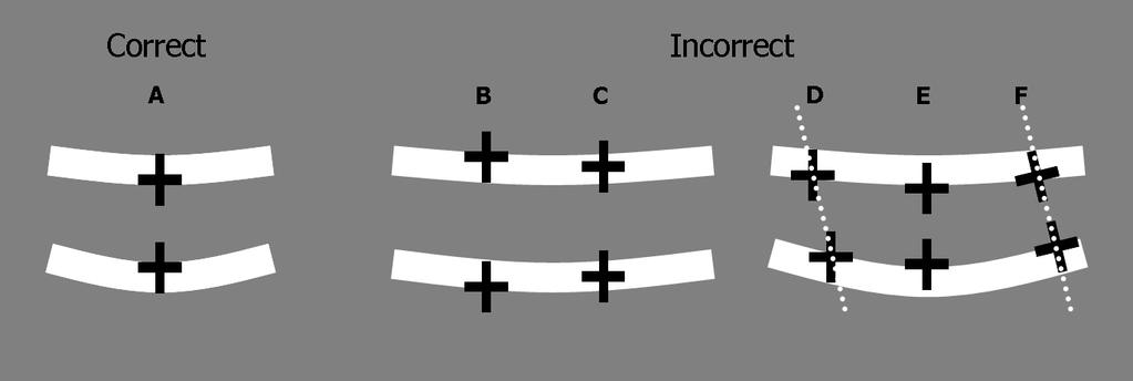 대한산부회지제 53 권제 1 호, 2010 Fig. 3. (A) Proper placement of the calipers for nuchal translucency (NT) measurement.
