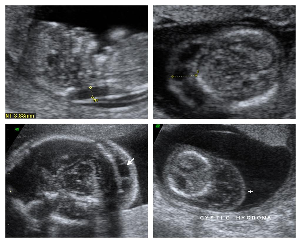 최석주. 태아목덜미투명대의임상적적용 A B C D Fig. 4. (A) Abnormally increased nuchal translucency (NT) in a fetus at 13 weeks of gestation. (B) A cystic hygroma in a fetus at 13 week of gestation.