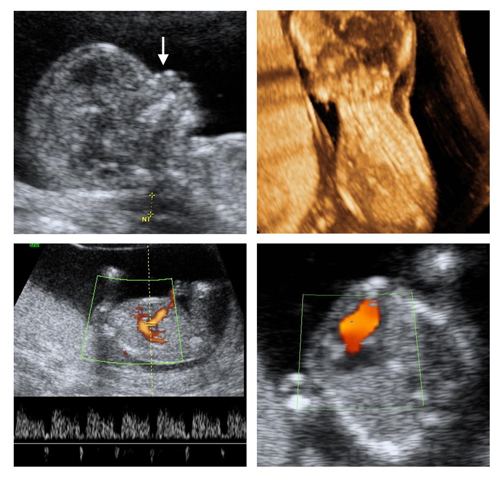 최석주. 태아목덜미투명대의임상적적용 A B C D Fig. 5. Abnormally increased nuchal translucency (NT) in a fetus at 13 weeks of gestation. (A) Nasal bone is invisible under the nasal skin shadow (arrow).