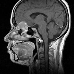 -The Korean Journal of Medicine : Vol. 71, No. 3, 2006 - A B Figure 1. Magnetic resonance image (MRI) of the paranasal sinus at the time of diagnosis.