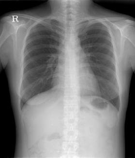 -Bo Kyeong Koo, et al : A case of ectopic adrenocorticotropic hormone syndrome with olfactory neuroblastoma - A B Figure 2. Simple X-ray image of the chest.