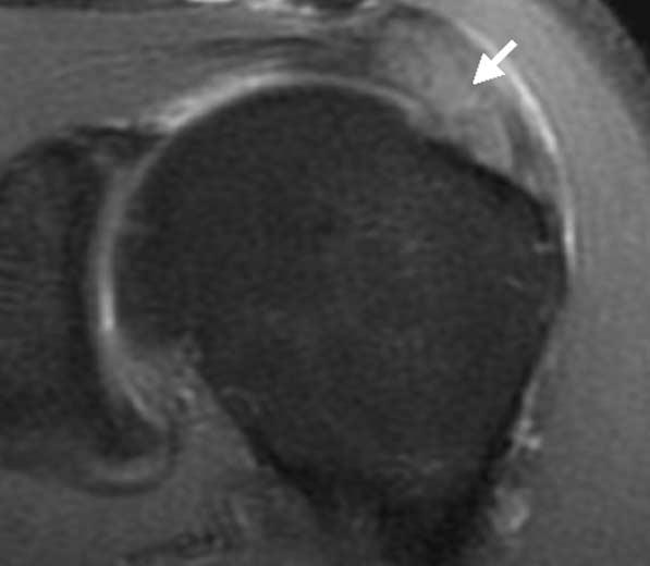 부분층파열로진단되었던증례들에대하여, 조영증강지방억제 A B C D Fig. 3. A 53-year-old man with full-thickness tear of the supraspinatus tendon with diffuse edematous change in the left shoulder.