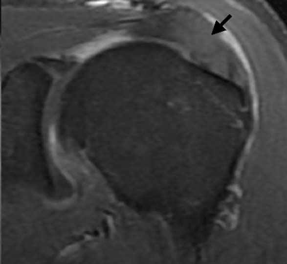 arrowhead, A), and contrast-enhanced fat-suppressed T1 weighted coronal image (black arrowhead, B).