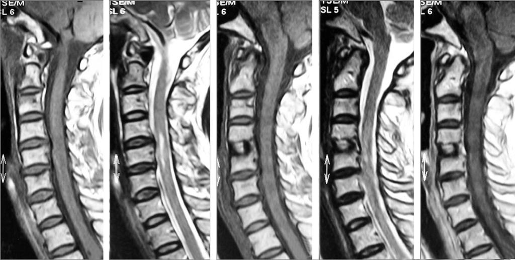 (C) Sagittal midline T1-weighted image shows isointensity lesion at C3-4 level. (D) T2-weighted image shows ill defined diffuse hyperintensity lesion at C3-4 level, indicating gliosis. Fig. 2.
