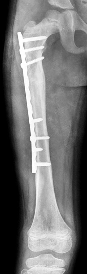 3) Beaty JH, Austin SM, Warner WC, Canale ST, Nichols L: Interlocking intramedullary nailing of femoral-shaft fractures in adolescents: preliminary results and complications.