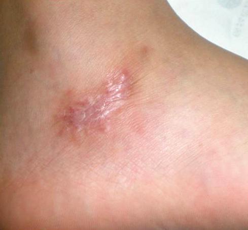 Photos show deep skin ulcers with irregular violaceous border that overhangs
