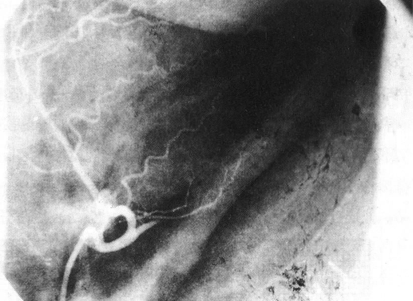 3) 1959년 Prinzmetal등1)이 안정시에 주기적으로 반 추적 관찰한 심초음파상 기저전벽, 중전 벽, 기저전측벽, 복적인 흉통을 호소하면서 심전도상에는 일시적인 ST 기저전중격에 새롭게 중등도의 저운동성이 관찰되었다.